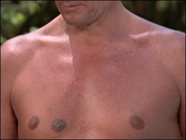 Prosthetic third nipple