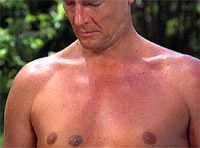 Prosthetic third nipple